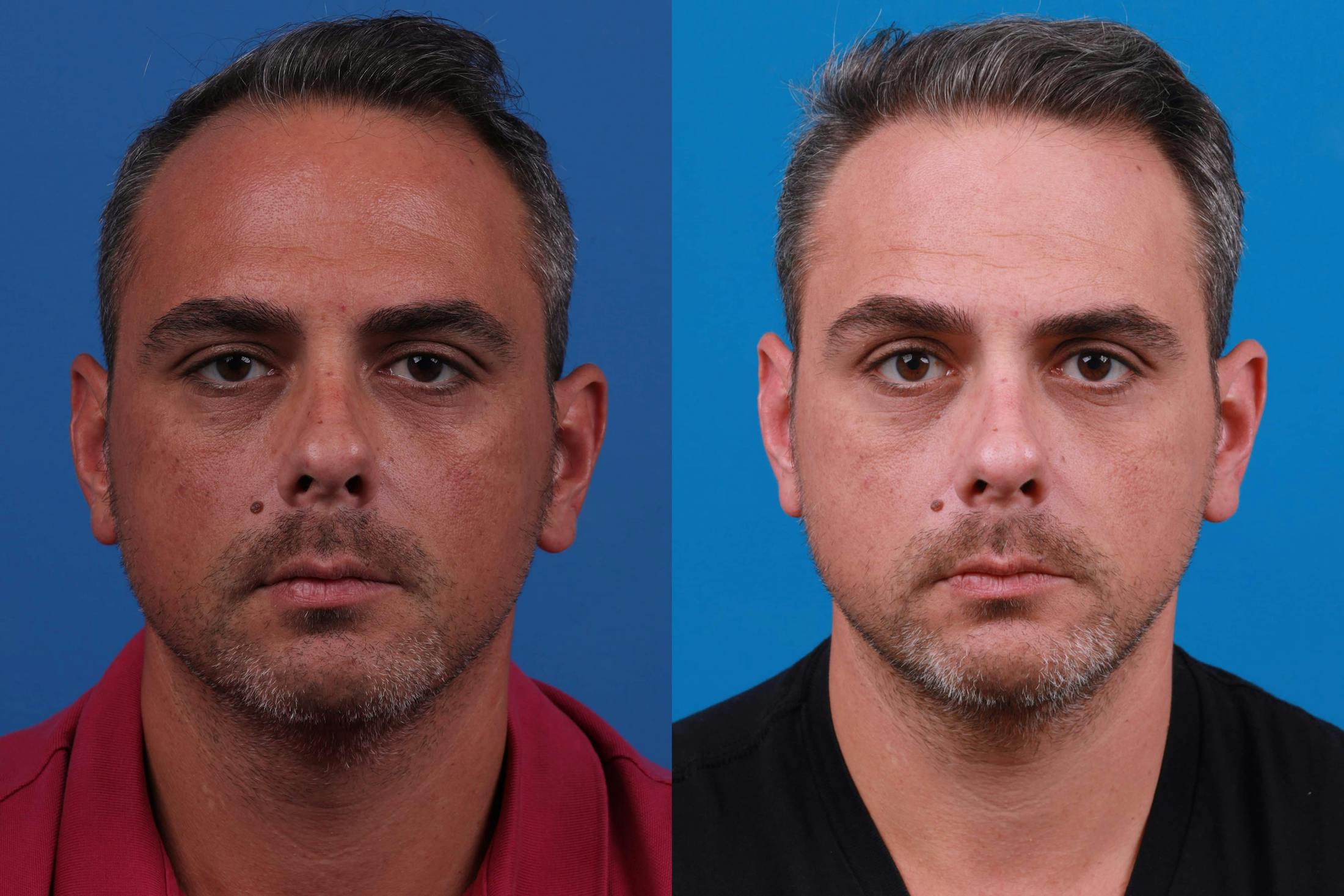 Hair Restoration Before & After Gallery - Patient 122593738 - Image 2