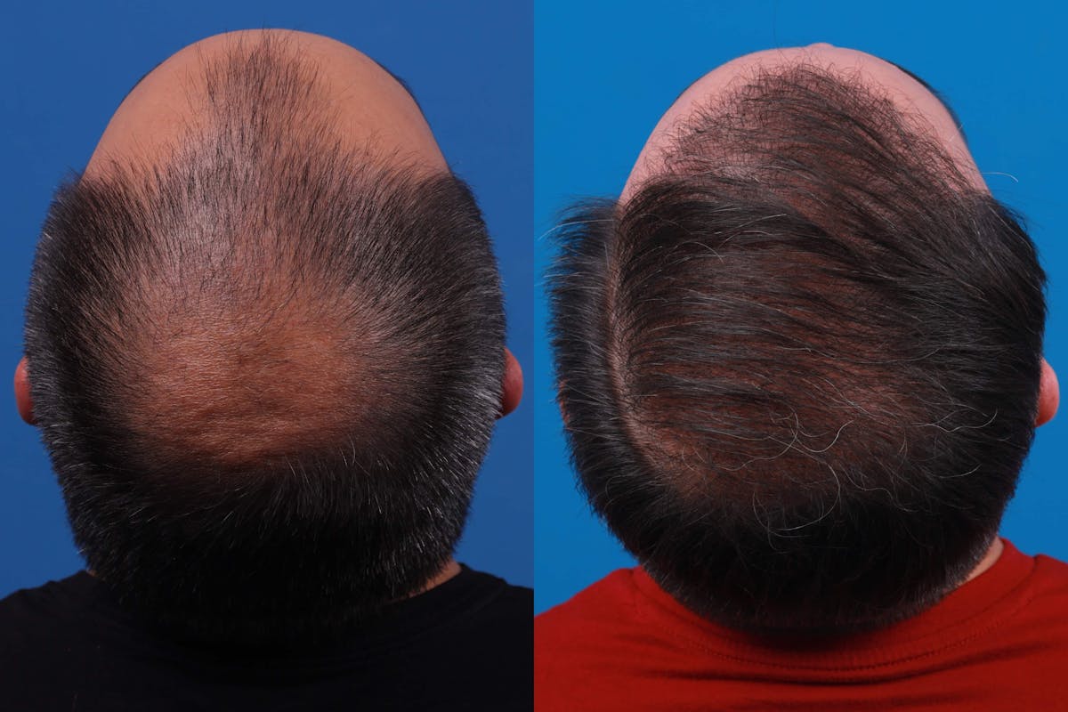 Hair Restoration Before & After Gallery - Patient 122593737 - Image 3