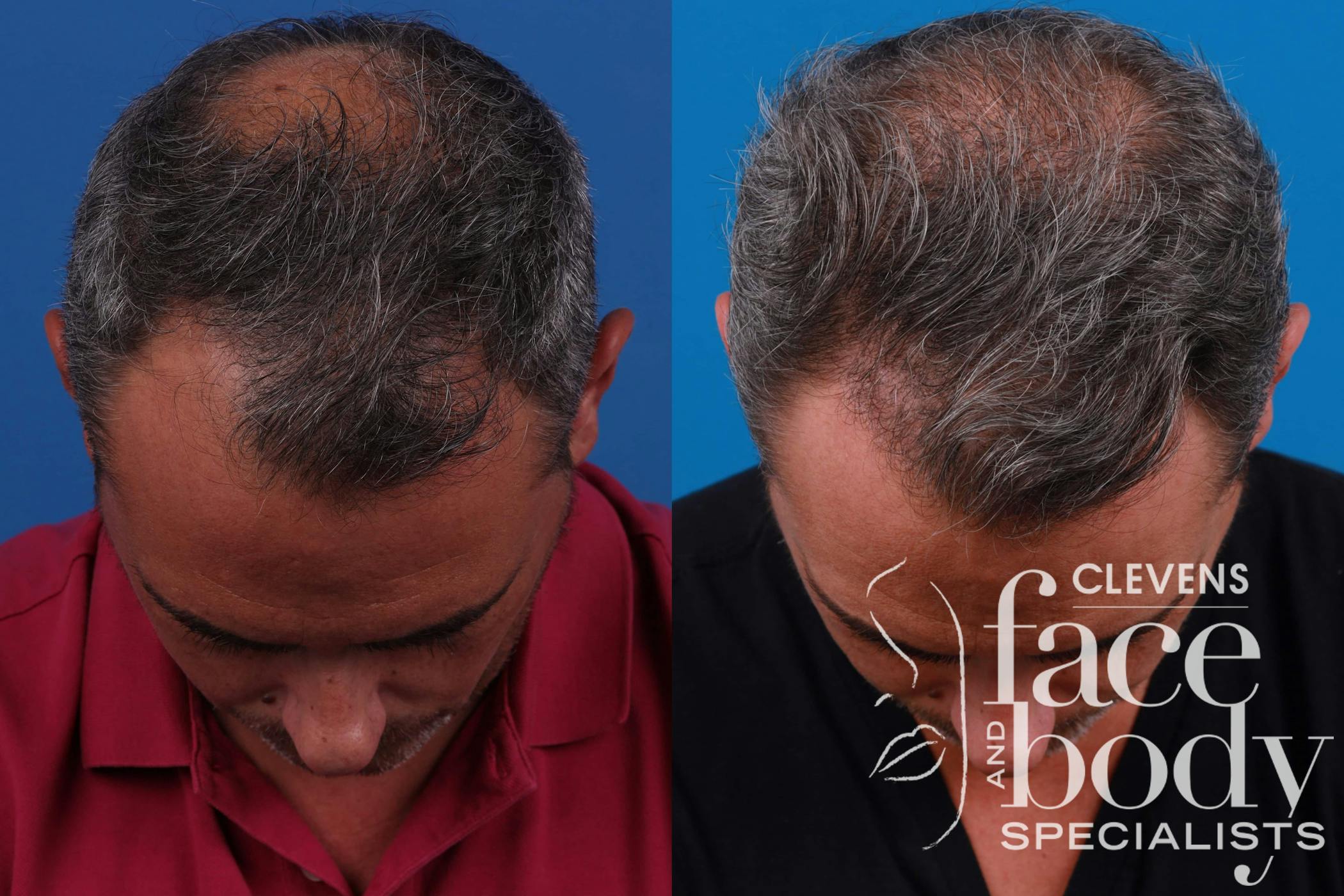 Hair Restoration