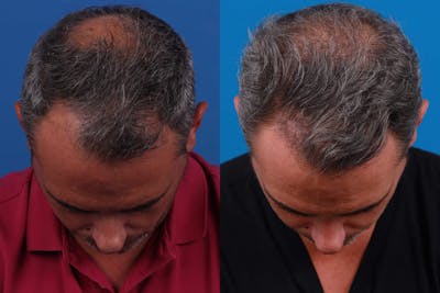 Hair Restoration Before & After Gallery - Patient 122593738 - Image 1