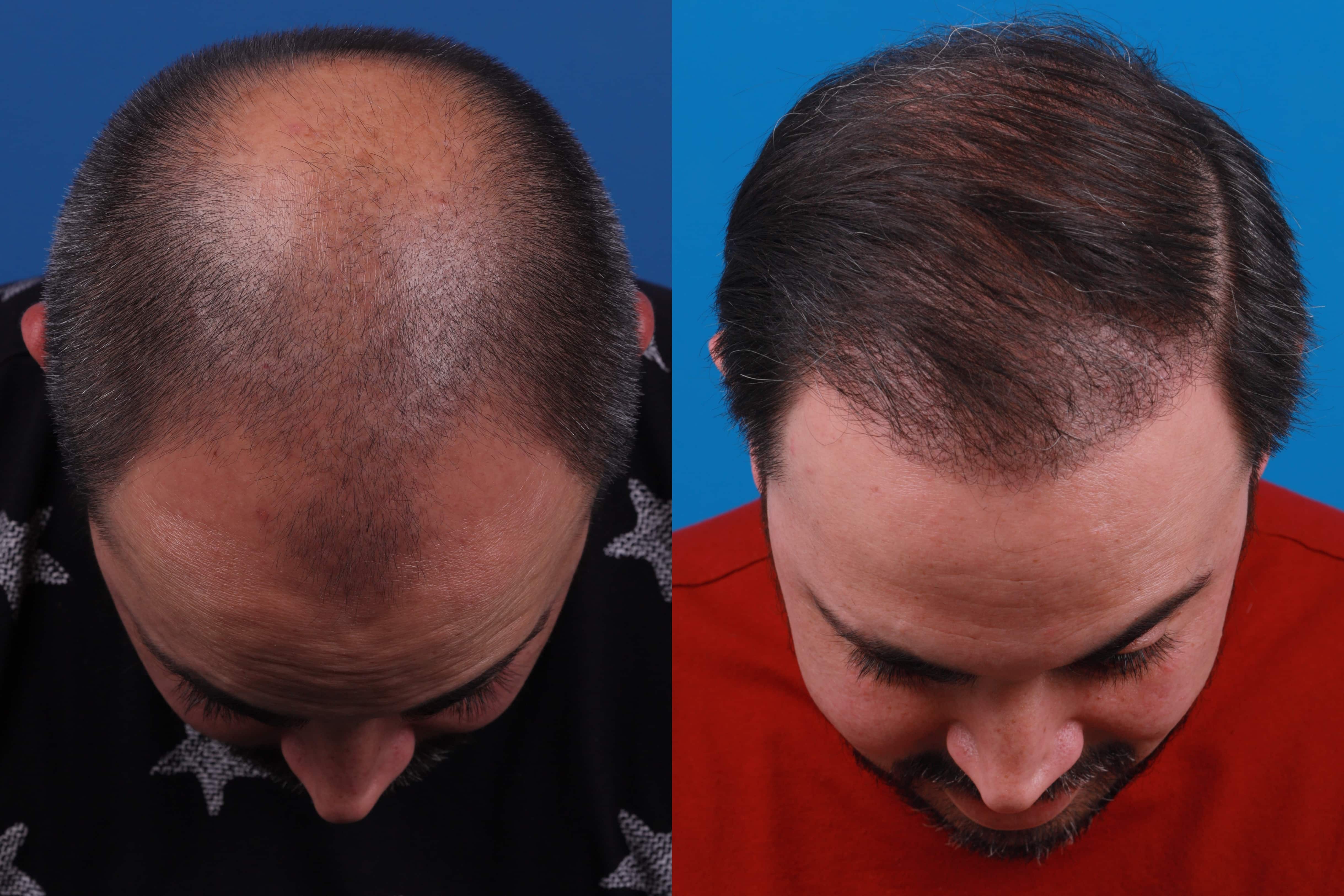 Hair Restoration Before & After Gallery - Patient 122593737 - Image 2