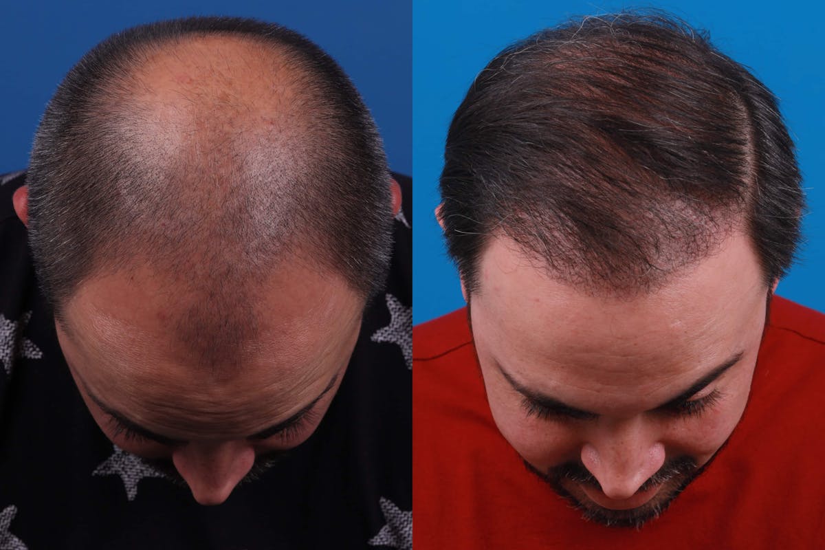 Hair Restoration Before & After Gallery - Patient 122593737 - Image 2