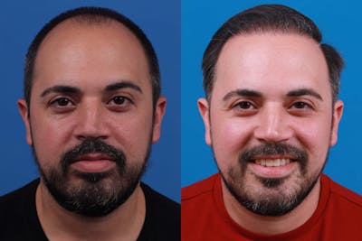 Hair Restoration Before & After Gallery - Patient 122593737 - Image 1