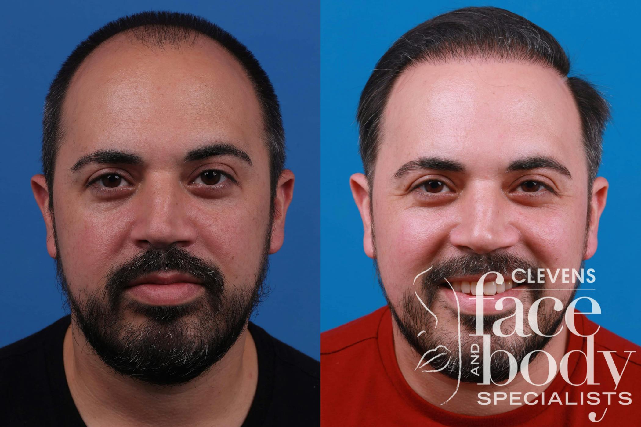 Hair Restoration