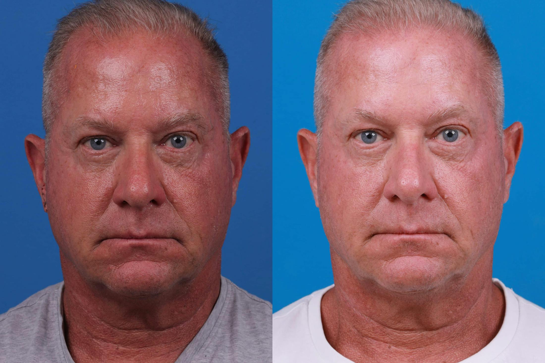 Hair Restoration Before & After Gallery - Patient 122593736 - Image 3