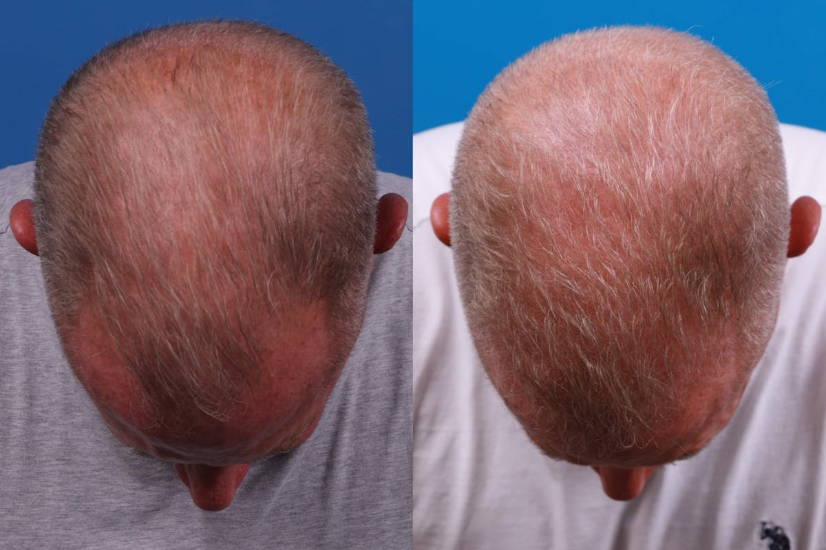 Hair Restoration Before & After Gallery - Patient 122593736 - Image 2