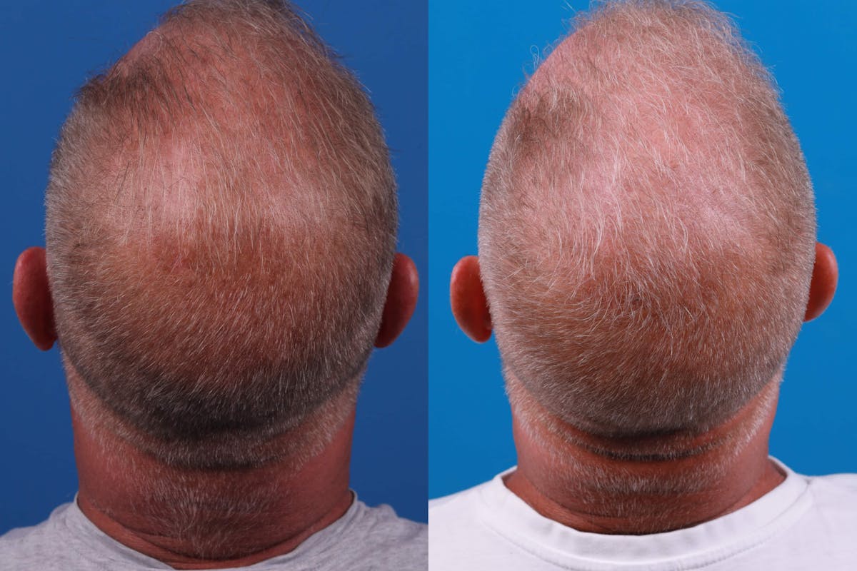 Hair Restoration Before & After Gallery - Patient 122593736 - Image 1