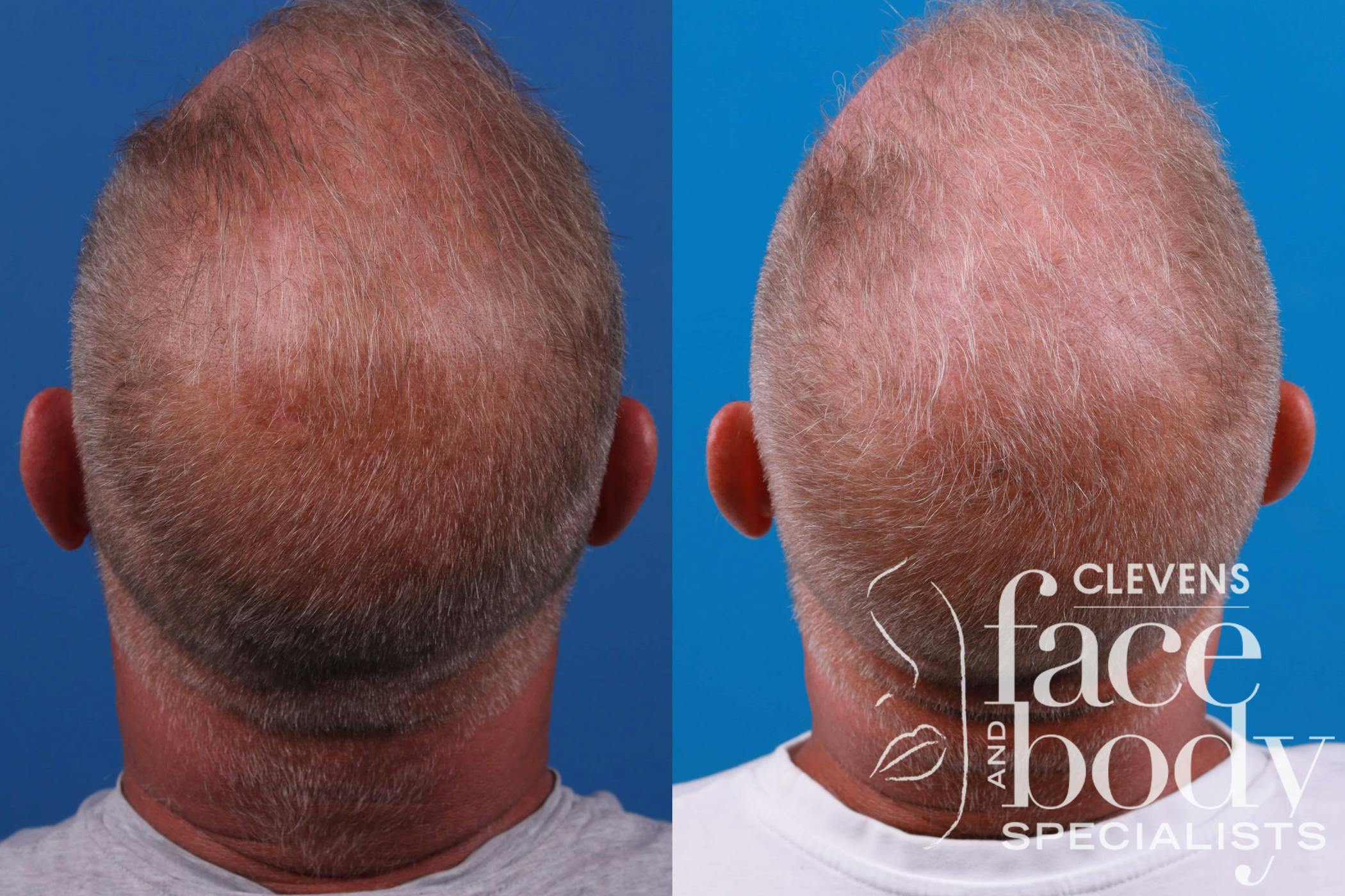 Hair Restoration