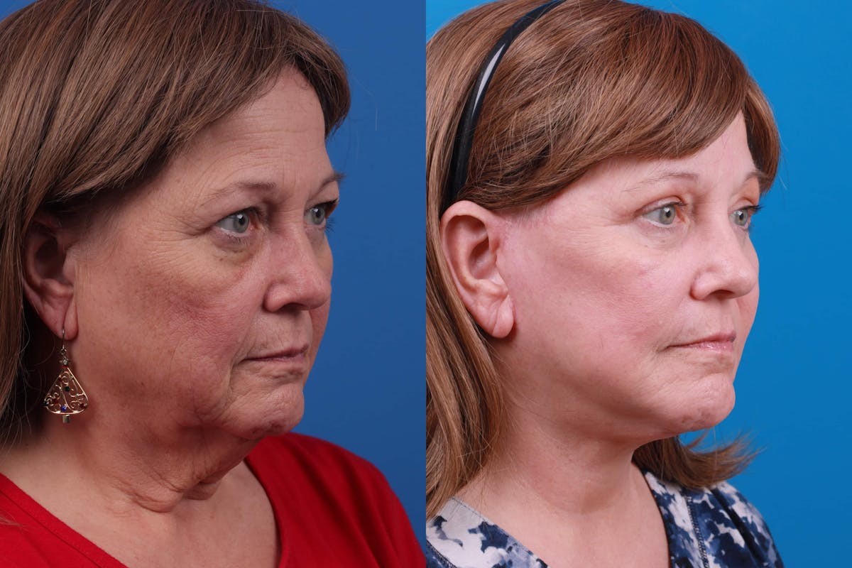 Facelift Before & After Gallery - Patient 122593605 - Image 4