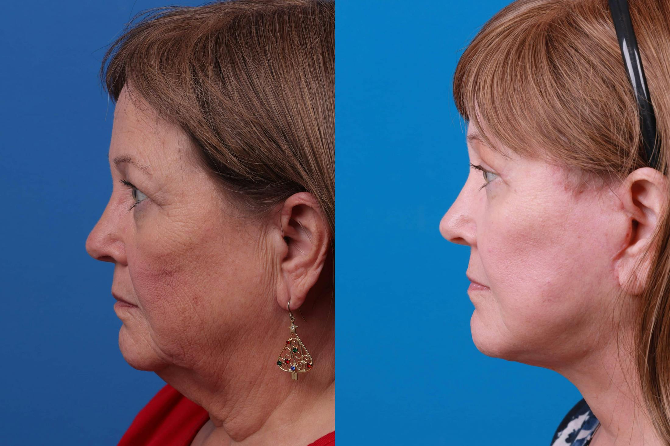 Facelift Before & After Gallery - Patient 122593605 - Image 3