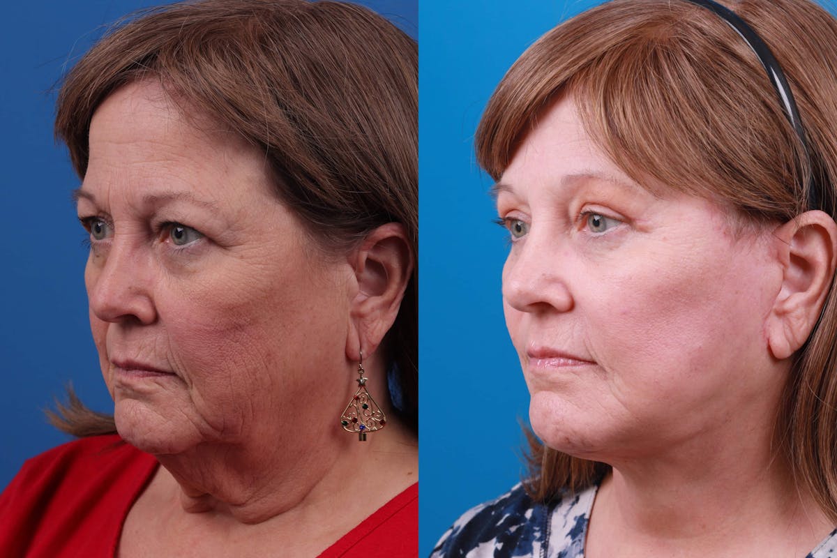 Facelift Before & After Gallery - Patient 122593605 - Image 2