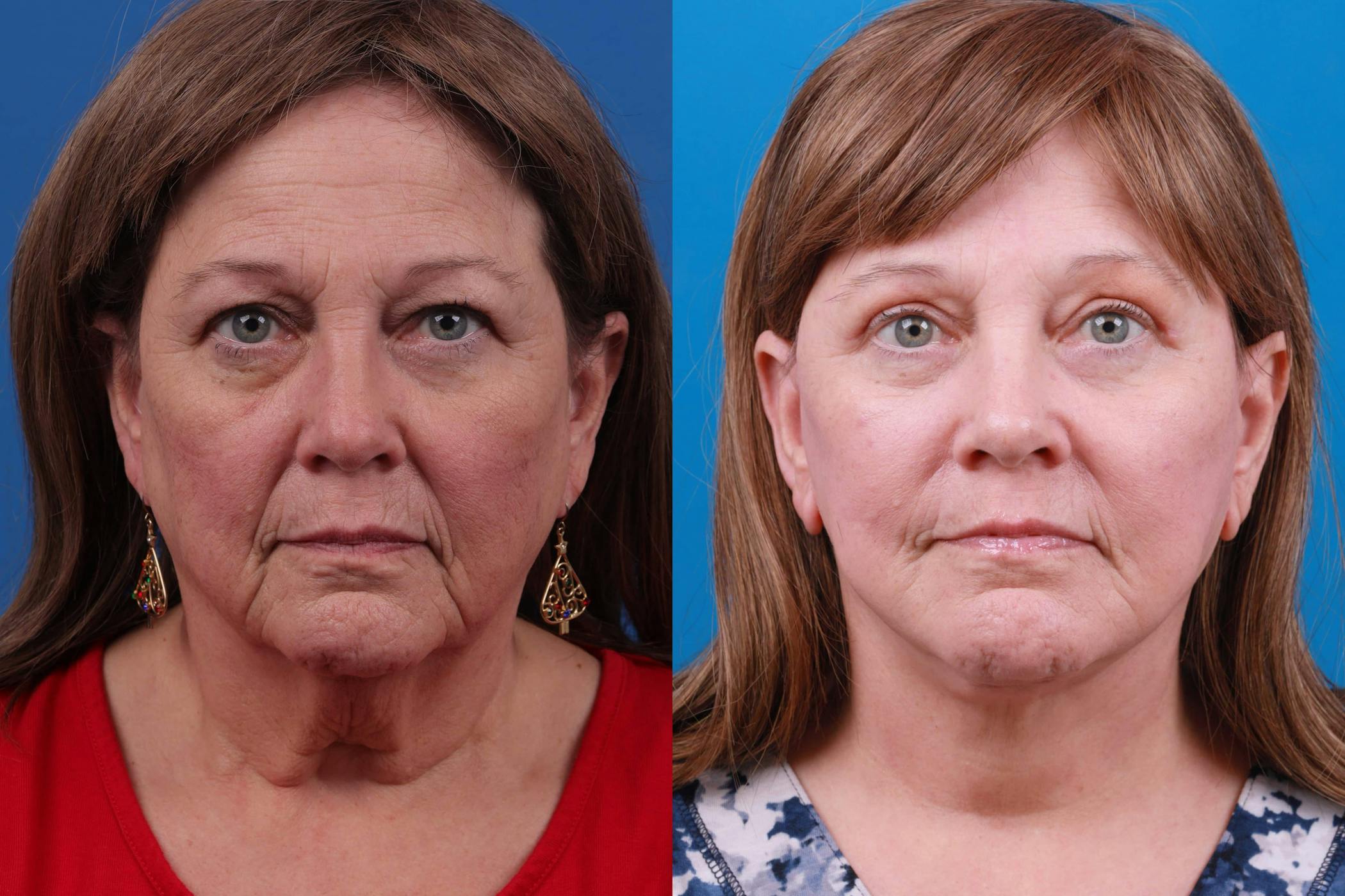 Before & after facelift surgery in Melbourne FL at Clevens Face and Body Specialists