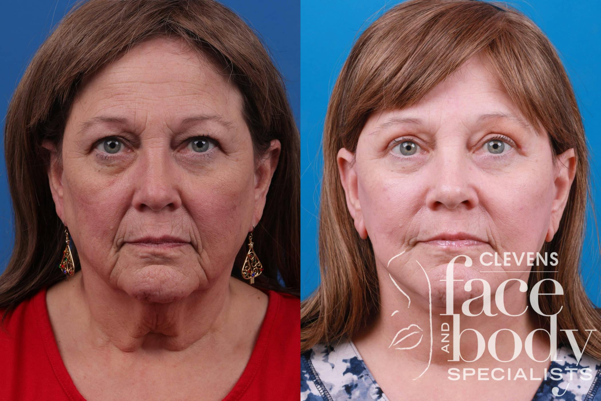 Before & after facelift surgery in Melbourne FL at Clevens Face and Body Specialists