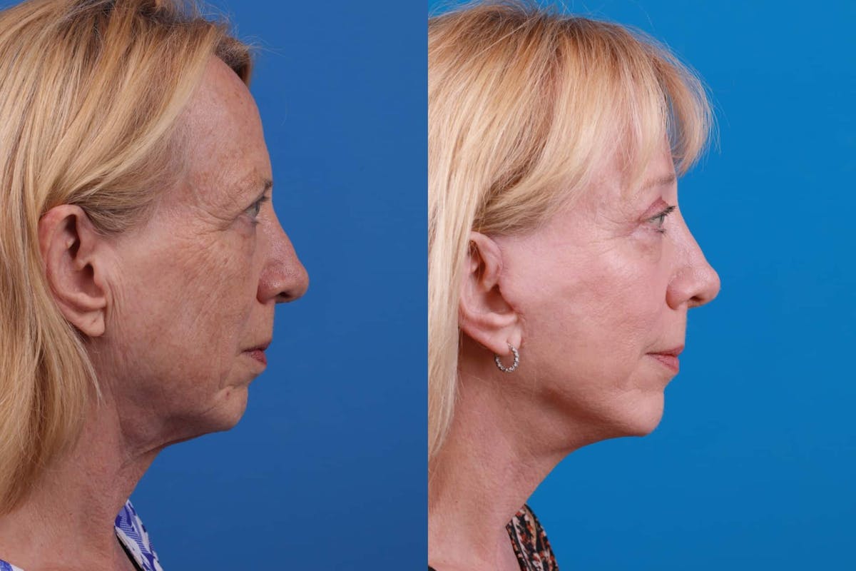 Facelift Before & After Gallery - Patient 122593604 - Image 5