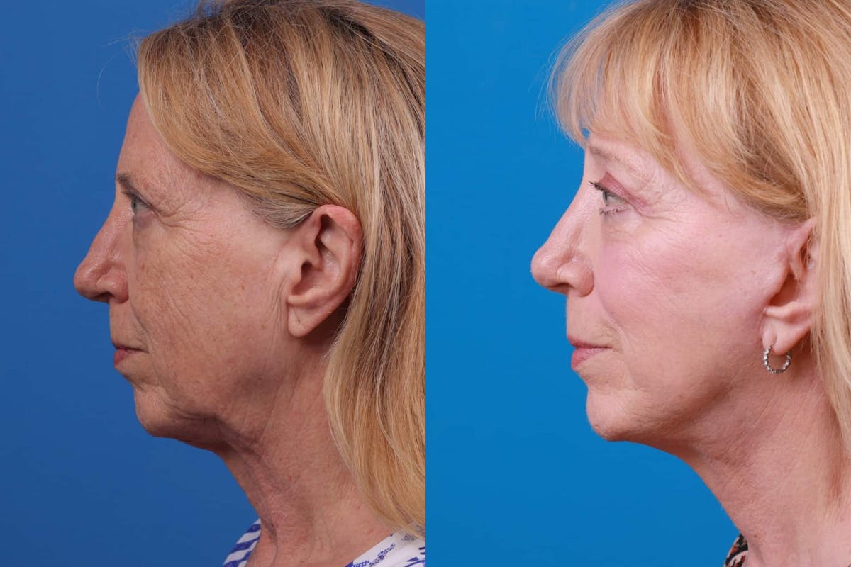 Facelift Before & After Gallery - Patient 122593604 - Image 4