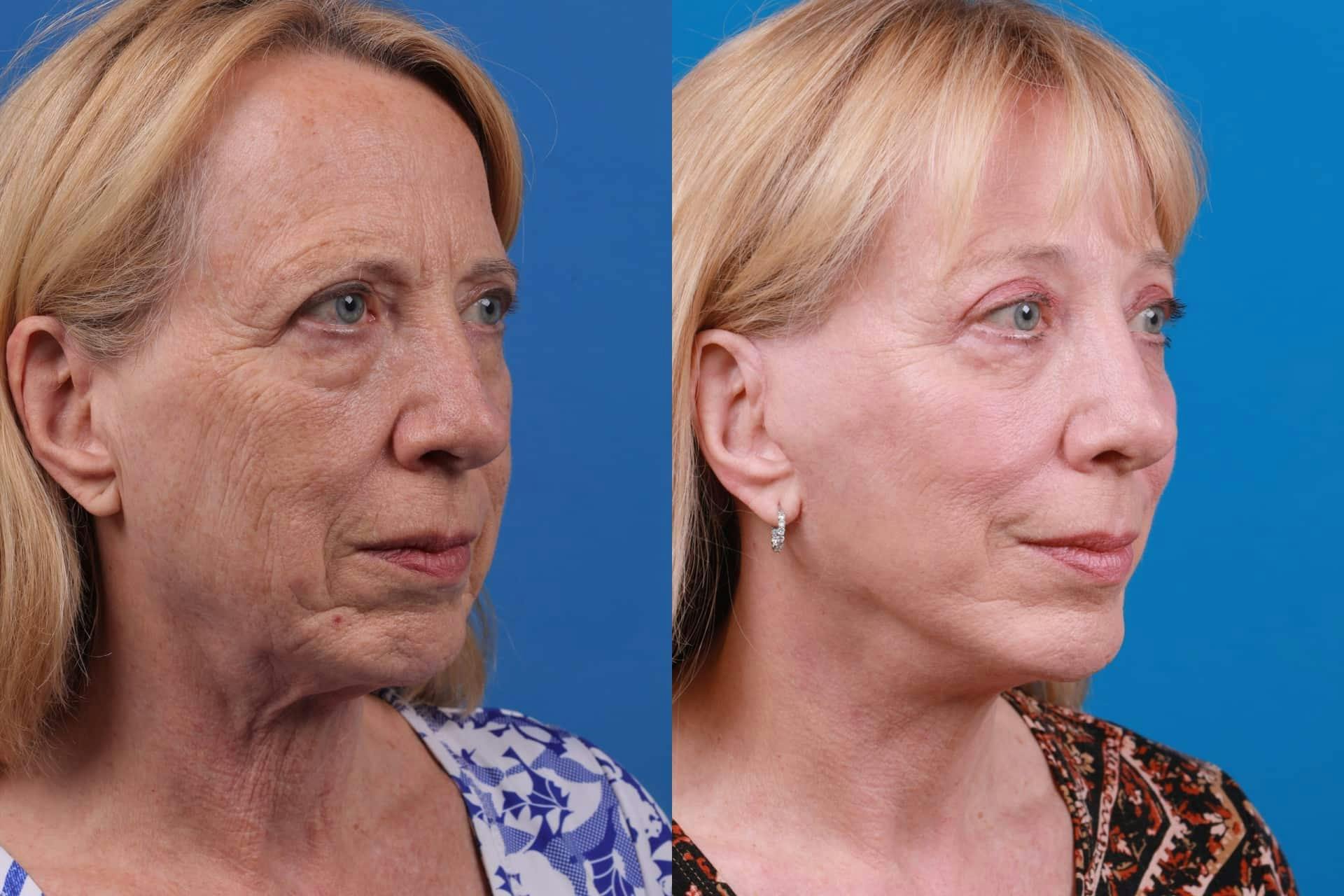 Facelift Before & After Gallery - Patient 122593604 - Image 3