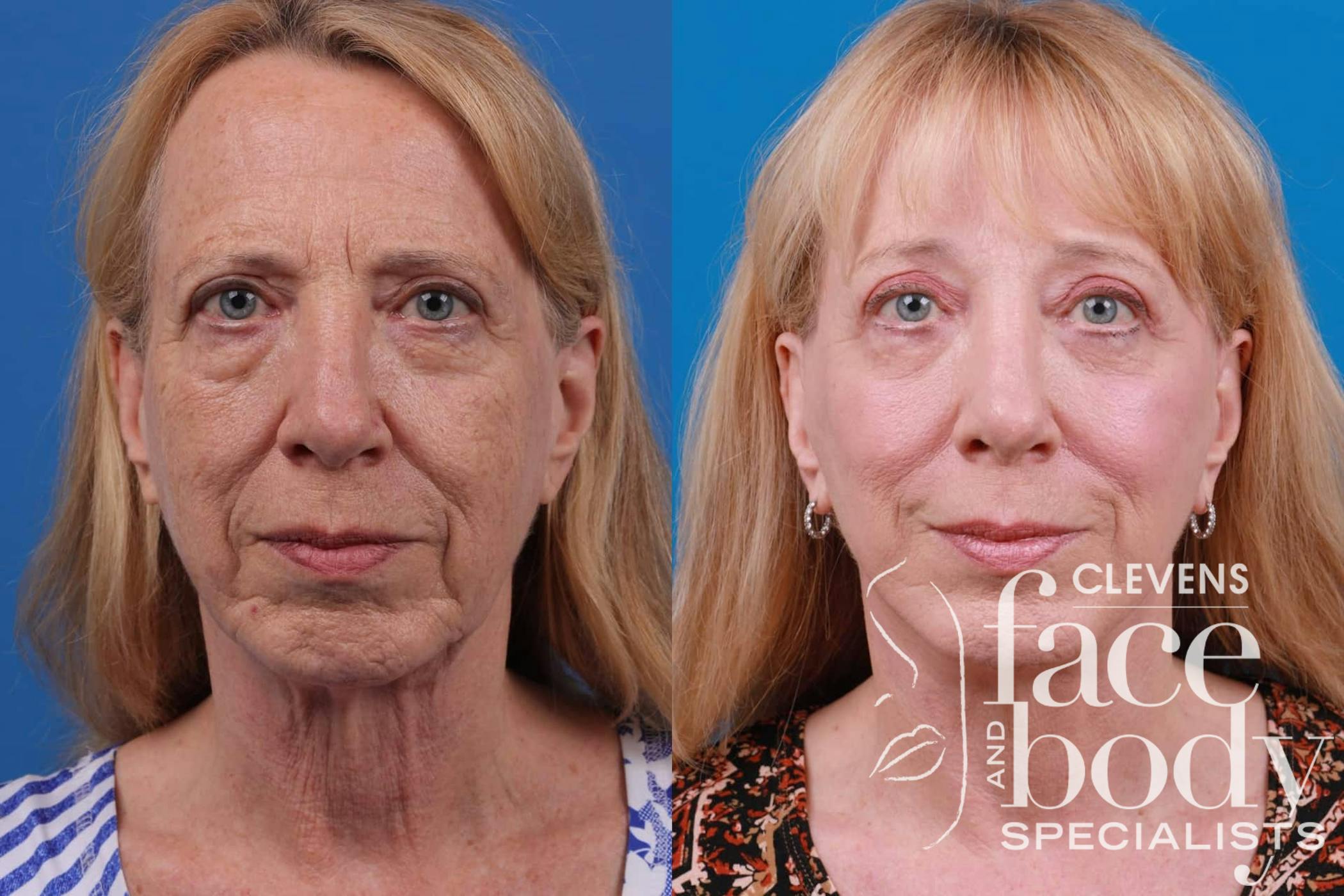 Facelift results in Merritt Island with Clevens Face and Body Specialists