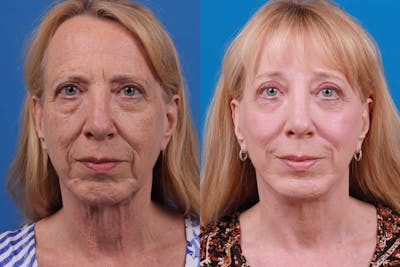 Facelift Before & After Gallery - Patient 122593604 - Image 1