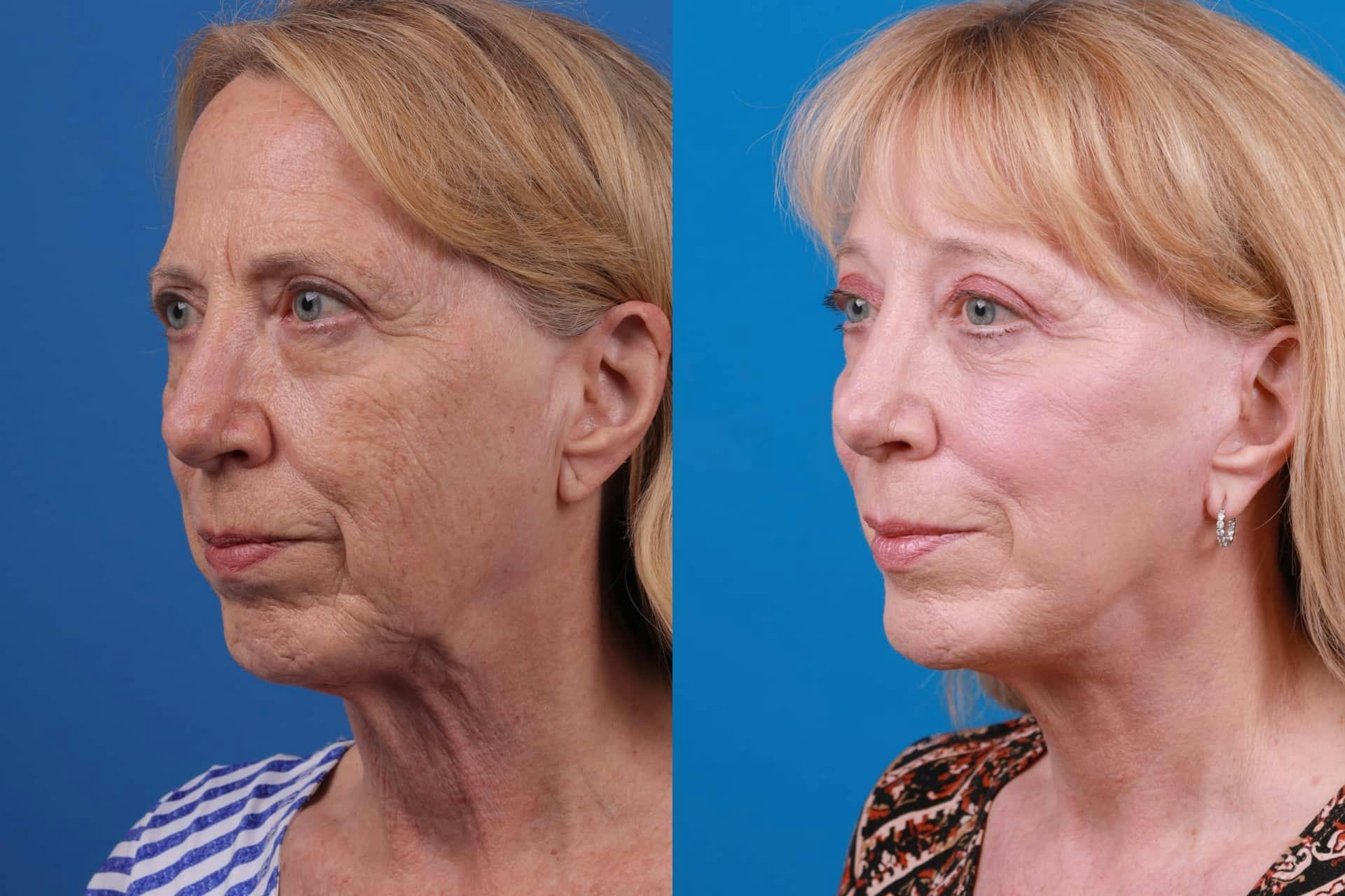 Facelift Before & After Gallery - Patient 122593604 - Image 2