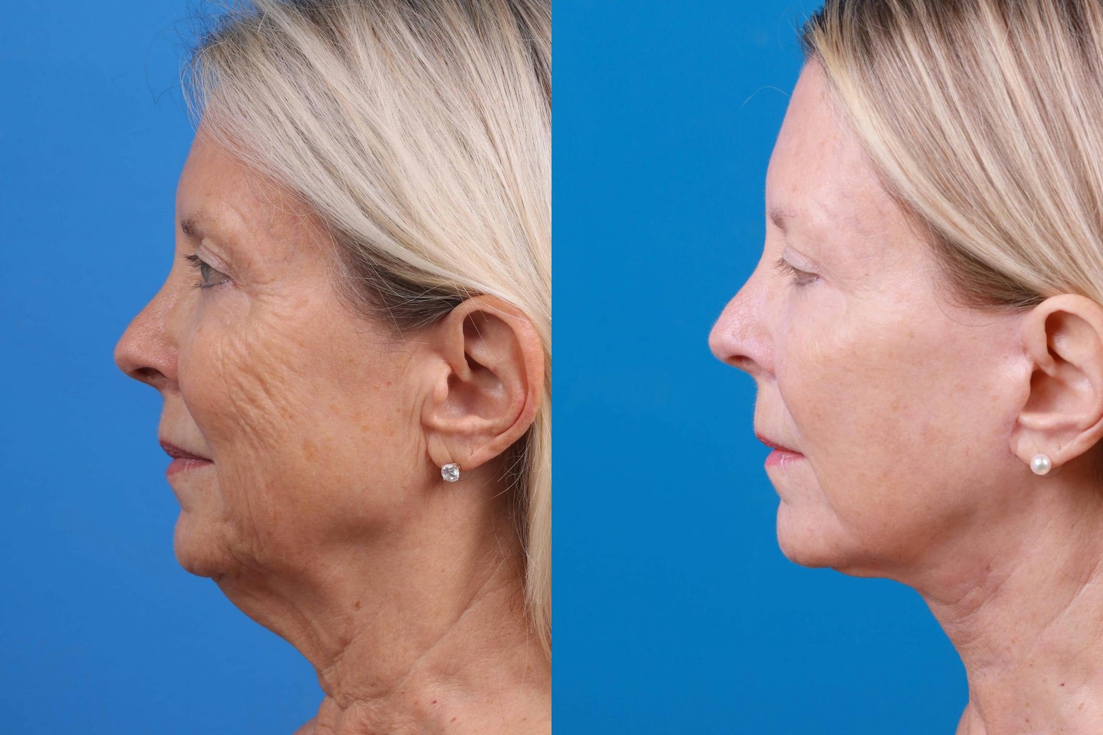 Facelift Before & After Gallery - Patient 122593603 - Image 5