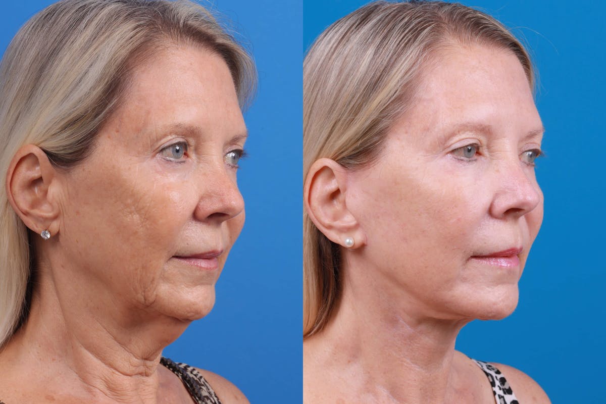 Facelift Before & After Gallery - Patient 122593603 - Image 2