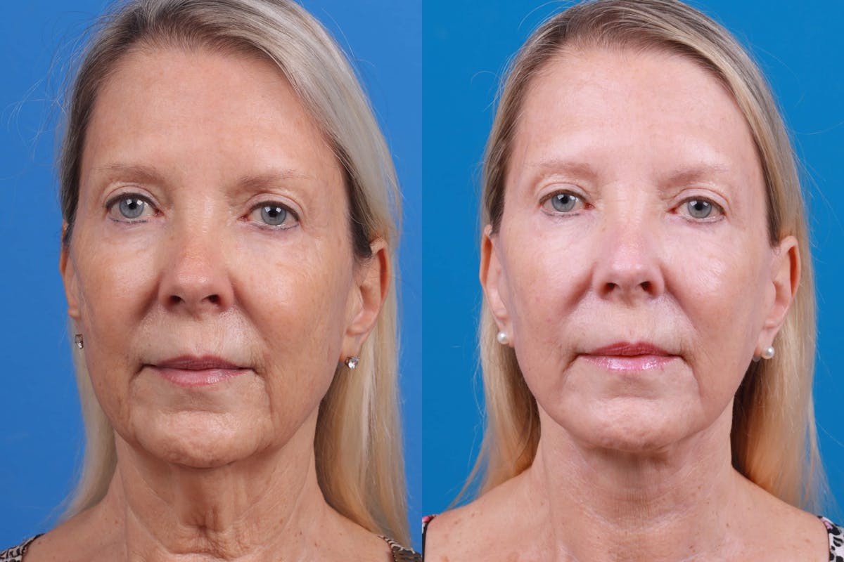Facelift Before & After Gallery - Patient 122593603 - Image 4