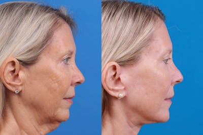 Facelift Before & After Gallery - Patient 122593603 - Image 1