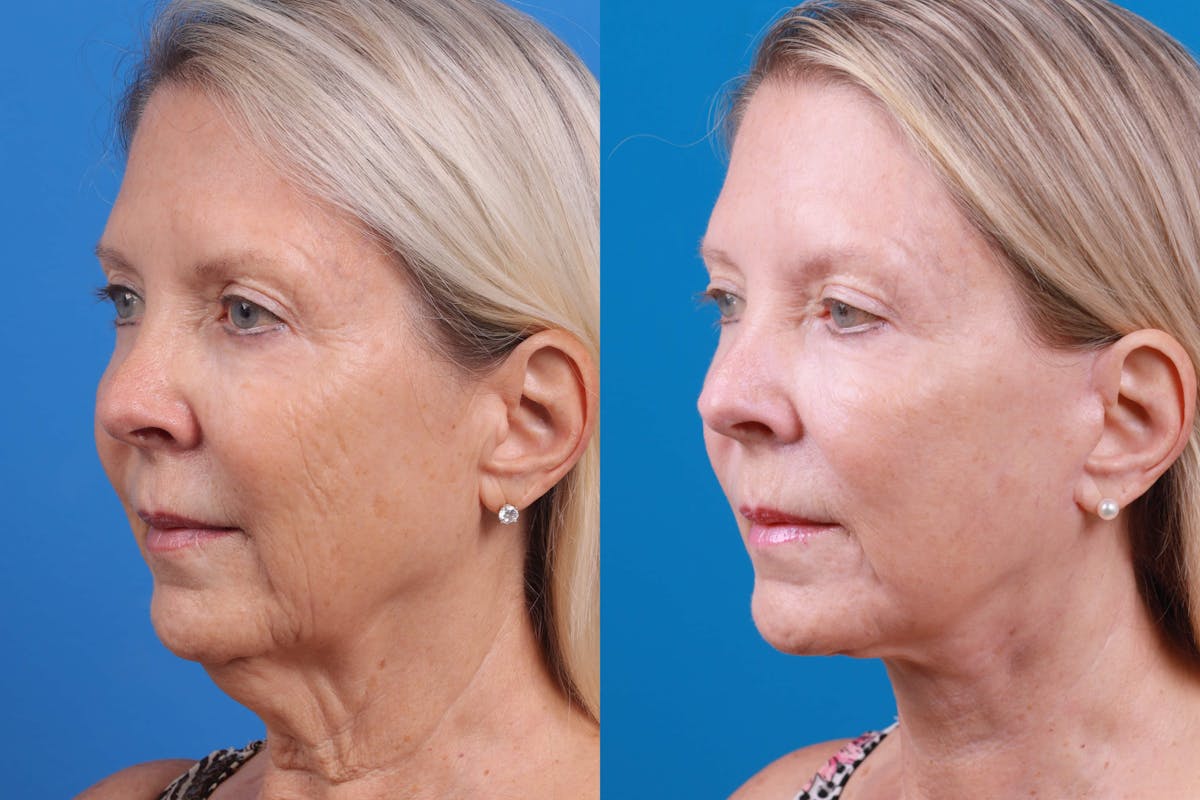 Facelift Before & After Gallery - Patient 122593603 - Image 3