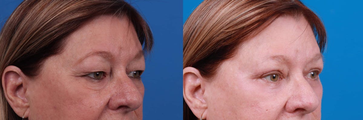 Eyelid Surgery Before & After Gallery - Patient 122592565 - Image 3