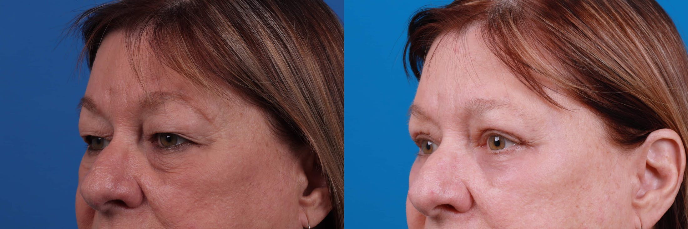 Eyelid Surgery Before & After Gallery - Patient 122592565 - Image 2