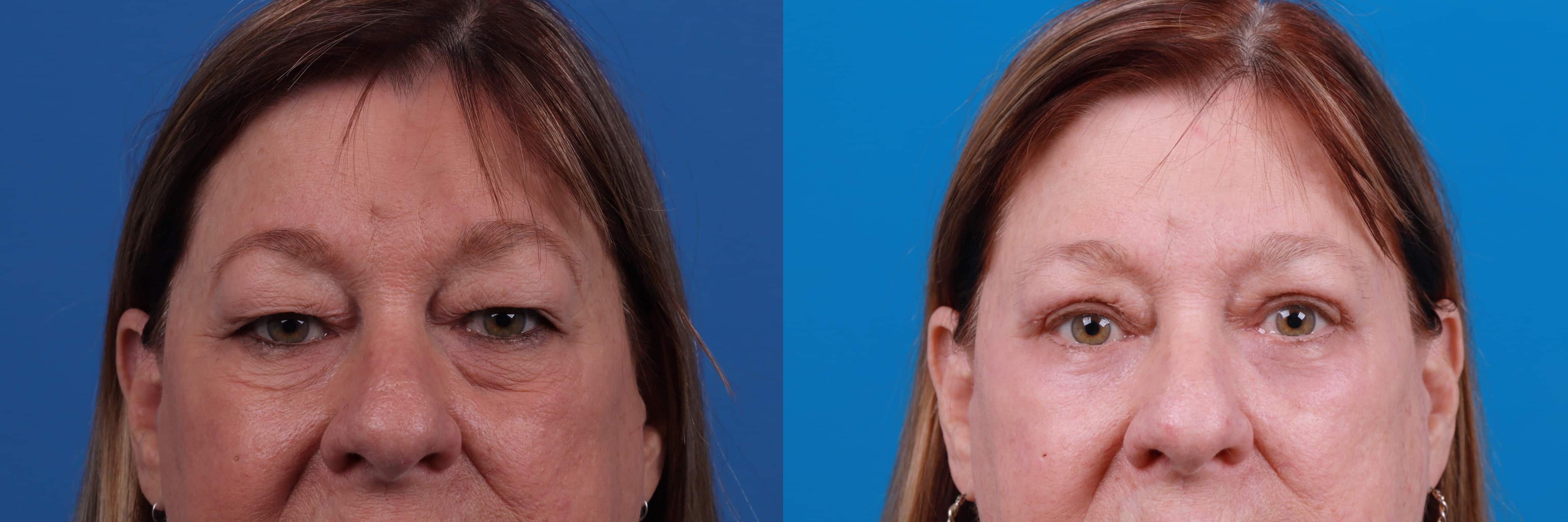 Eyelid Surgery Before & After Gallery - Patient 172334 - Image 1