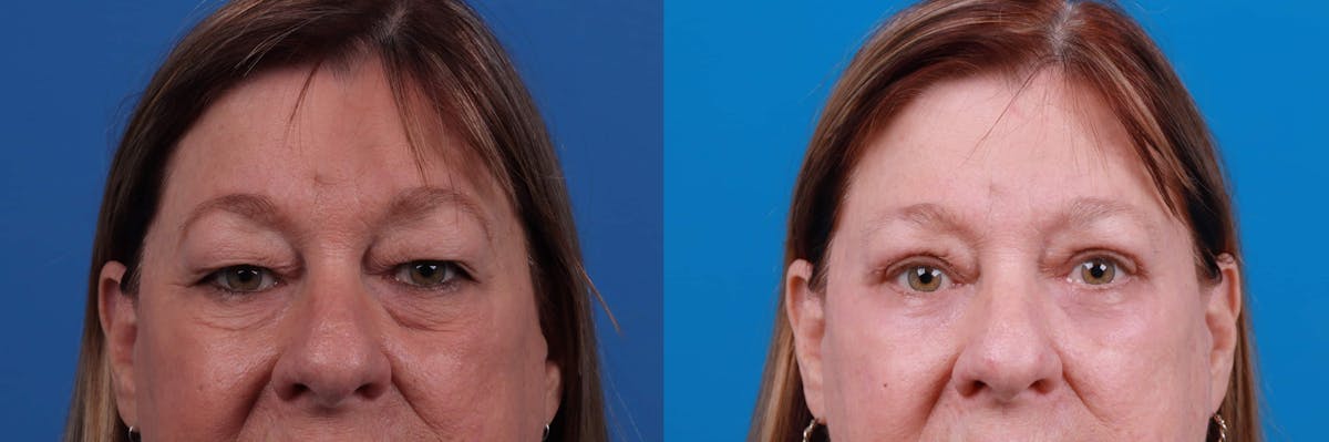 Eyelid Surgery Before & After Gallery - Patient 122592565 - Image 1