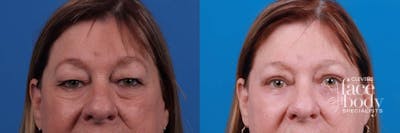 Eyelid Surgery Before & After Gallery - Patient 172334 - Image 1