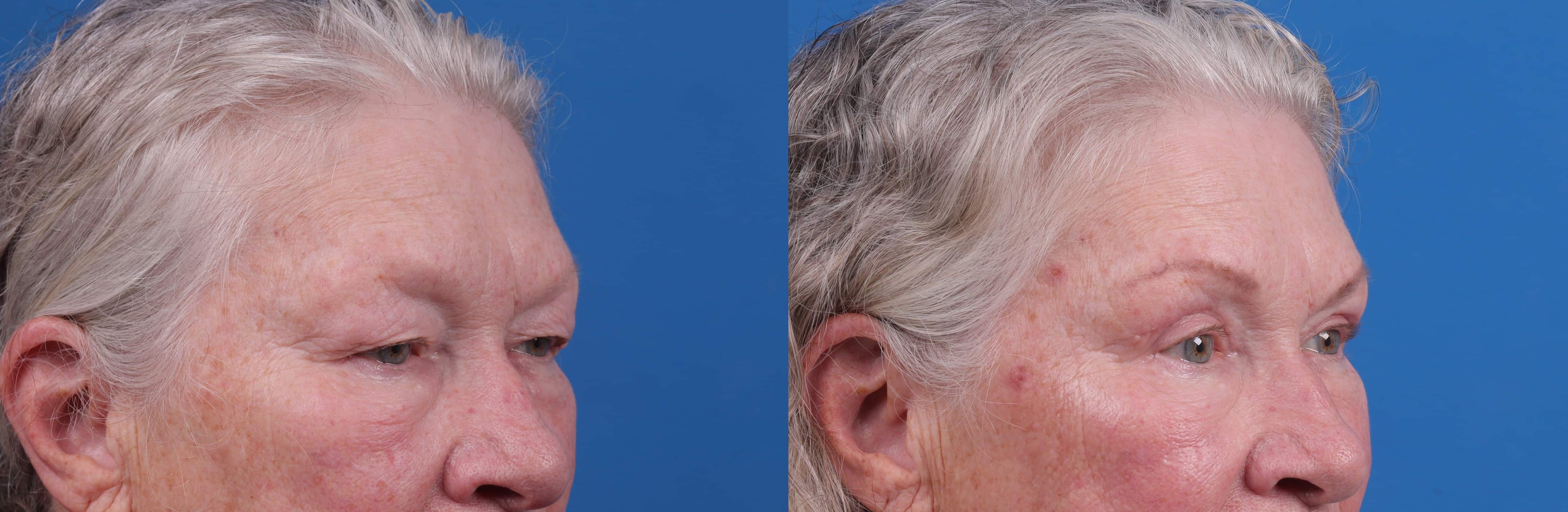 Eyelid Surgery Before & After Gallery - Patient 127648 - Image 3