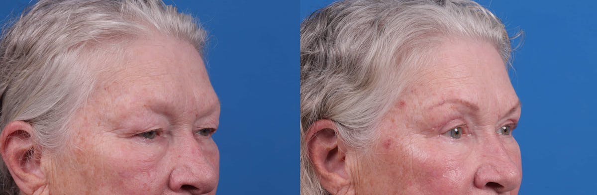 Eyelid Surgery Before & After Gallery - Patient 122592566 - Image 3
