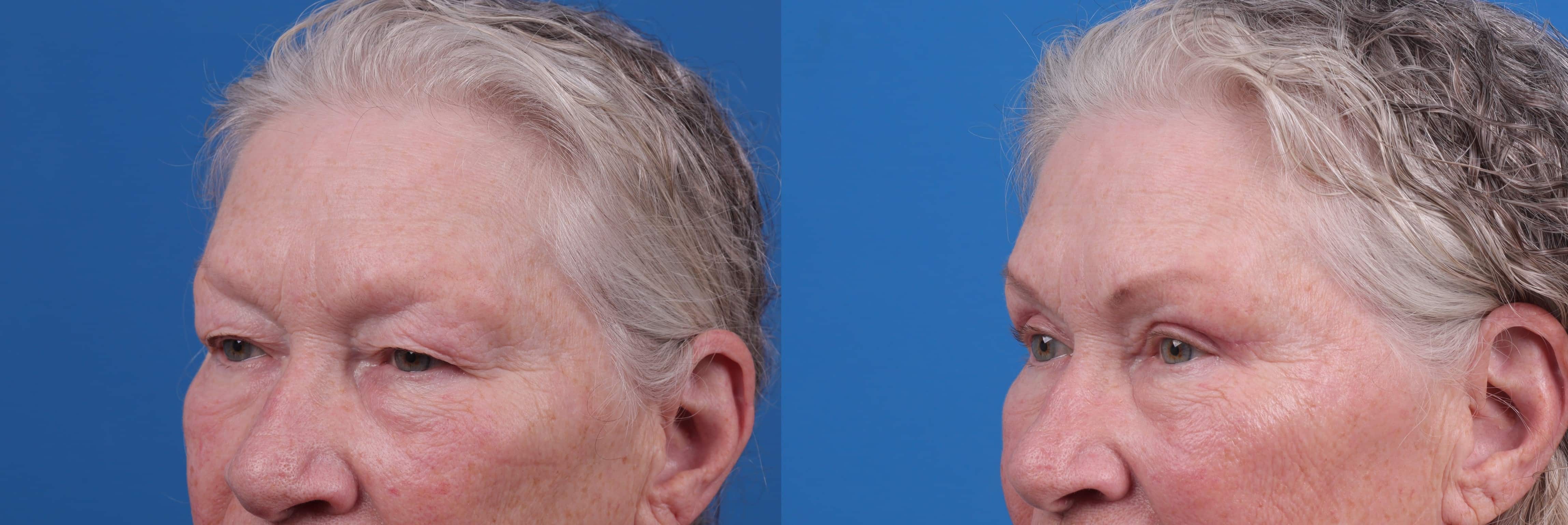 Eyelid Surgery Before & After Gallery - Patient 127648 - Image 2