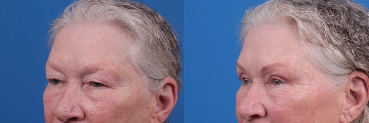 Eyelid Surgery Before & After Gallery - Patient 122592566 - Image 2