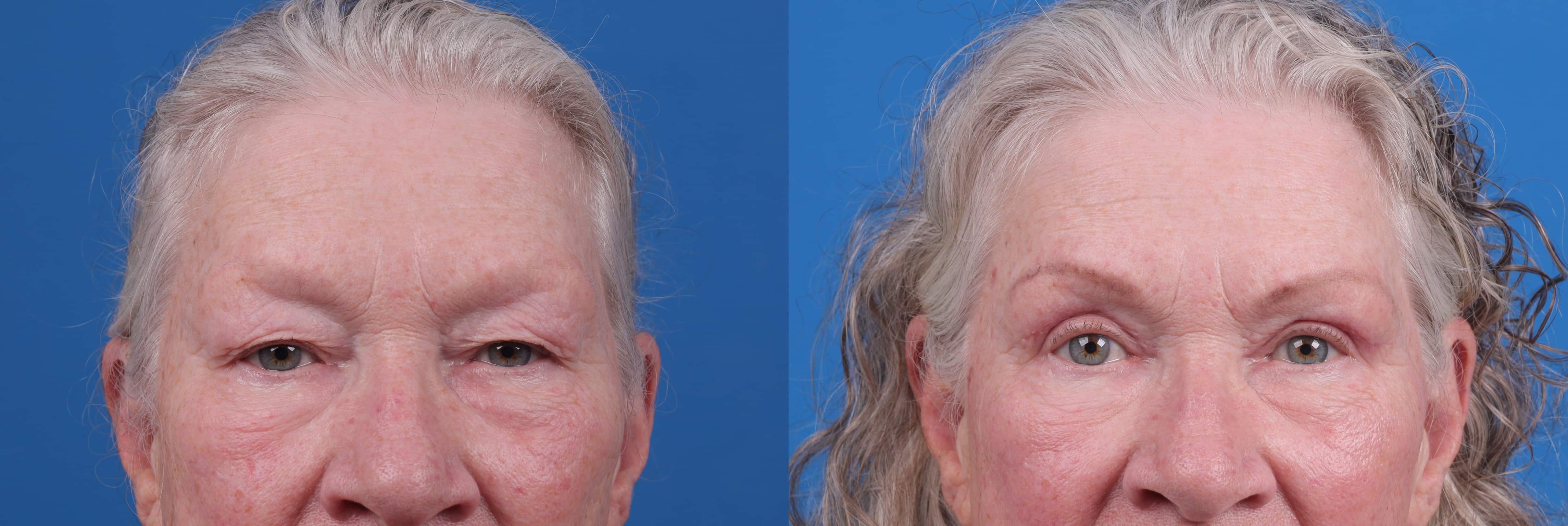 Eyelid Surgery Before & After Gallery - Patient 127648 - Image 1