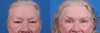 Eyelid Surgery Before & After Gallery - Patient 122592566 - Image 1
