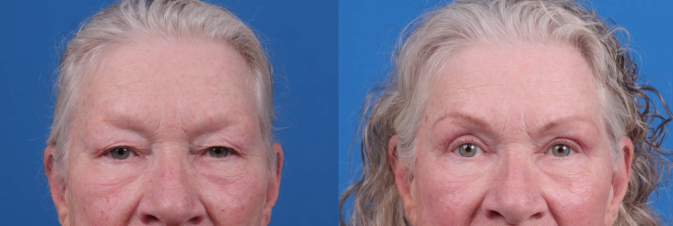 Eyelid Surgery Before & After Gallery - Patient 122592566 - Image 1