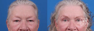 Eyelid Surgery Before & After Gallery - Patient 127648 - Image 1