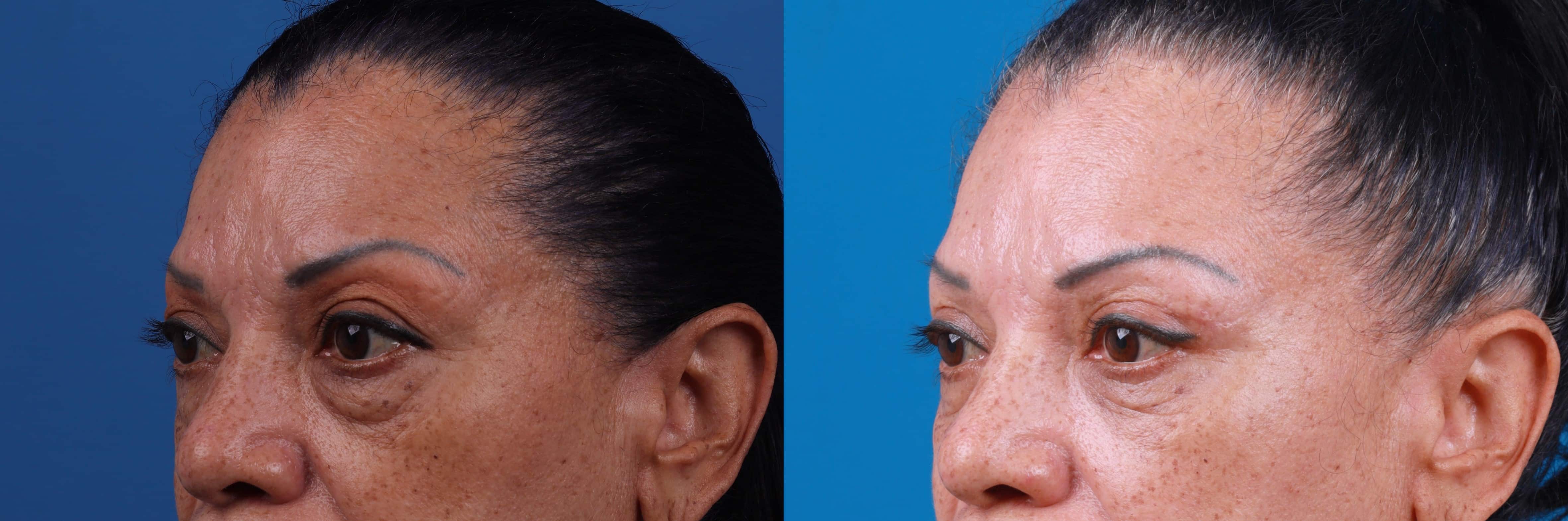 Eyelid Surgery Before & After Gallery - Patient 693055 - Image 3
