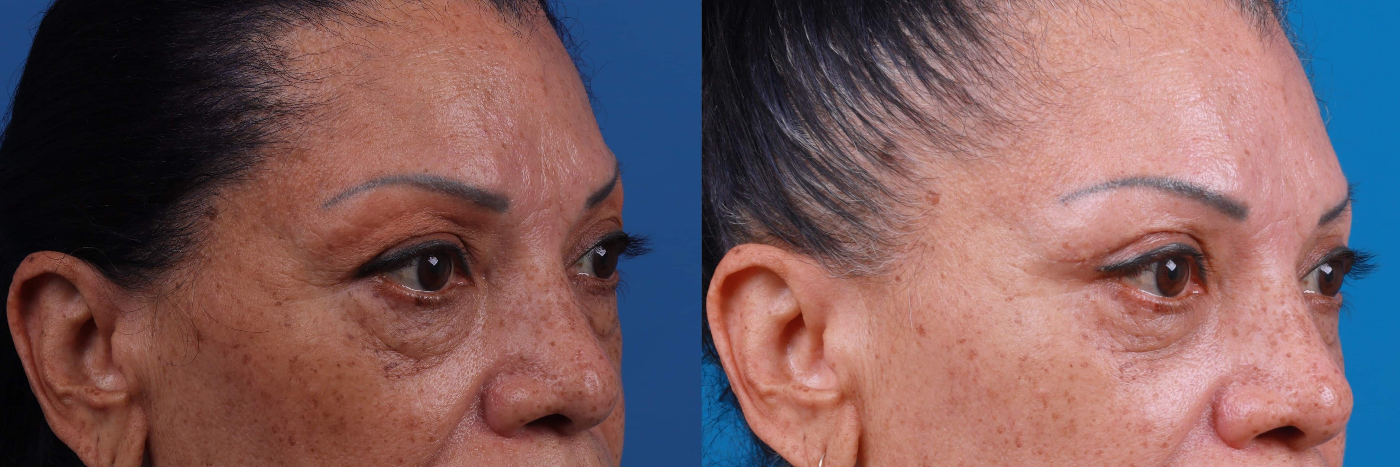 Eyelid Surgery Before & After Gallery - Patient 693055 - Image 2