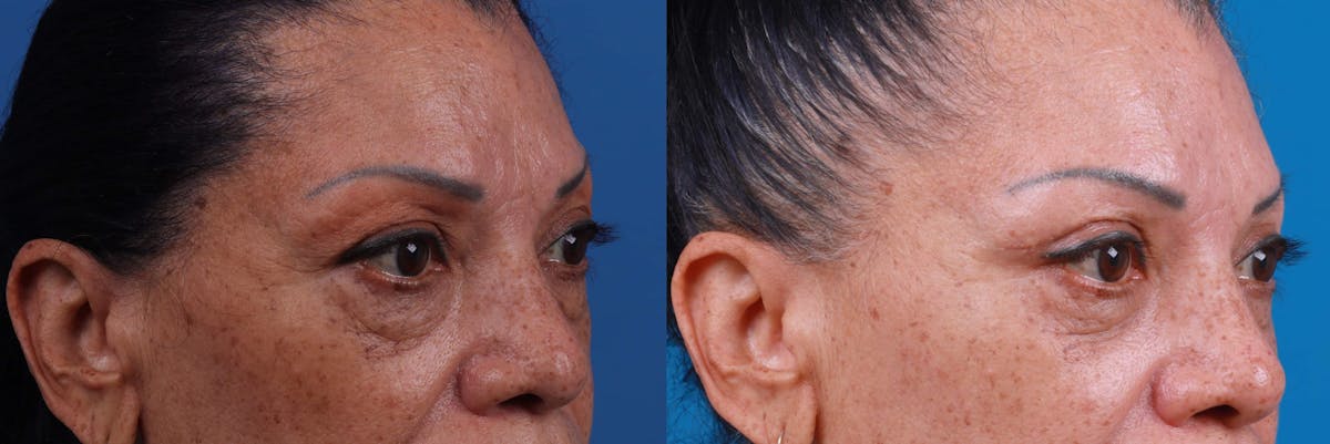 Eyelid Surgery Before & After Gallery - Patient 122592567 - Image 2