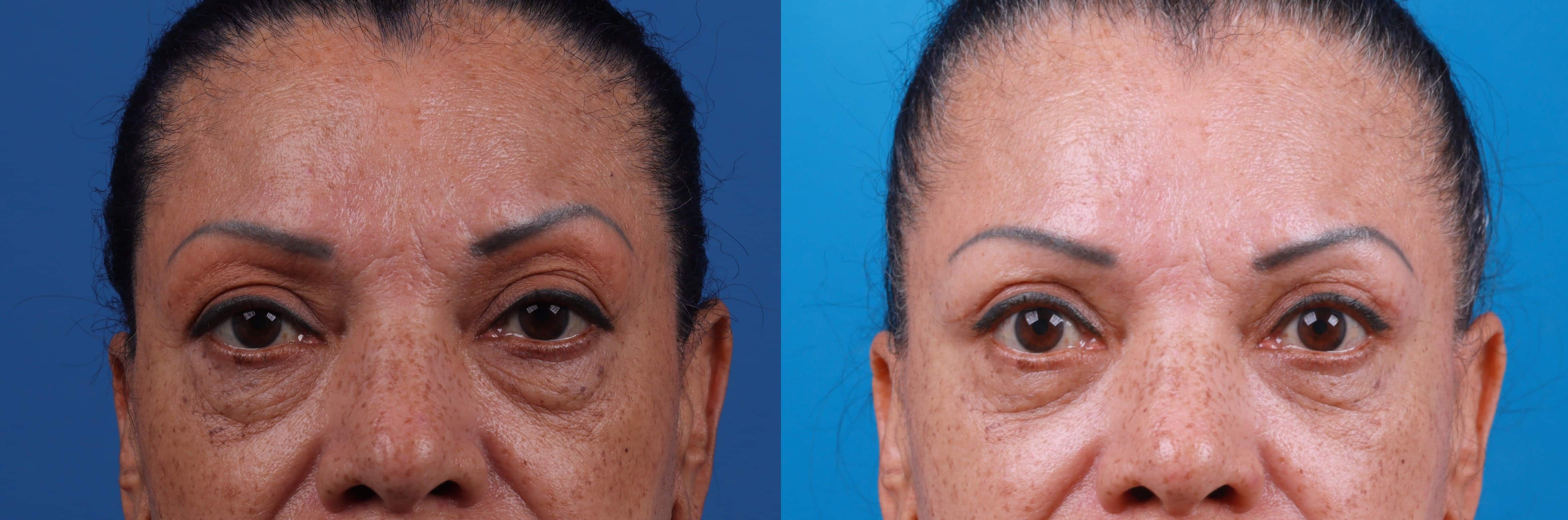 Eyelid Surgery Before & After Gallery - Patient 693055 - Image 1