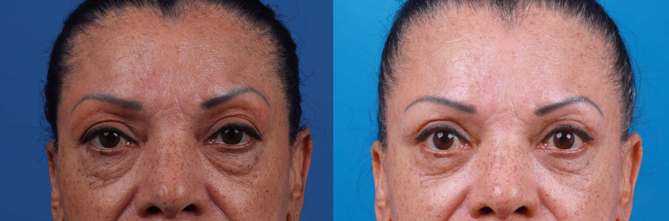 Eyelid Surgery Before & After Gallery - Patient 122592567 - Image 1