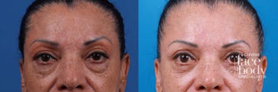 Eyelid Surgery Before & After Gallery - Patient 693055 - Image 1