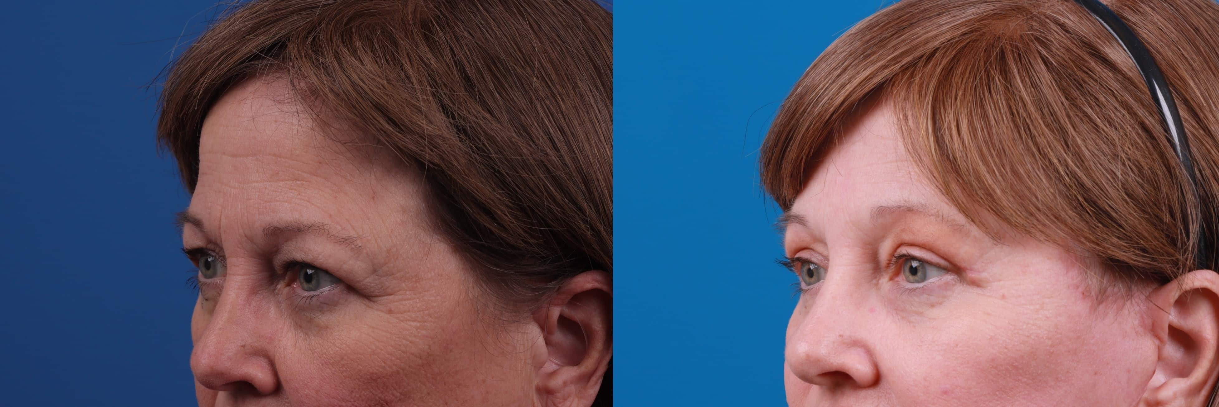 Eyelid Surgery Before & After Gallery - Patient 127787 - Image 3