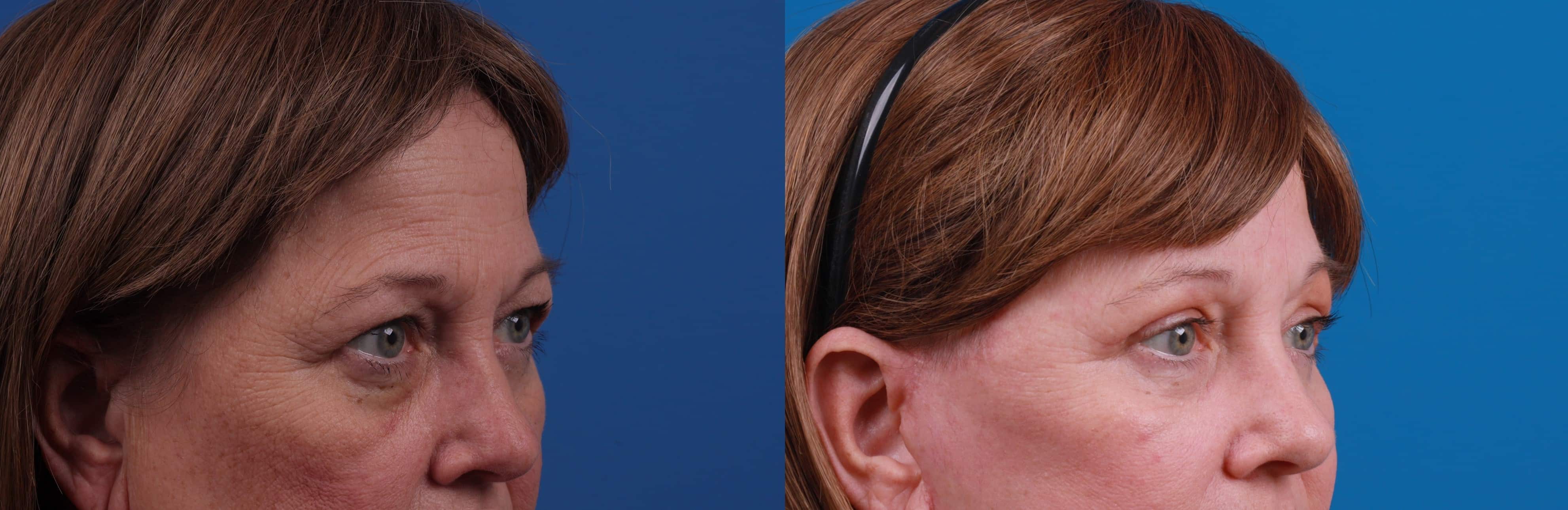 Eyelid Surgery Before & After Gallery - Patient 127787 - Image 2