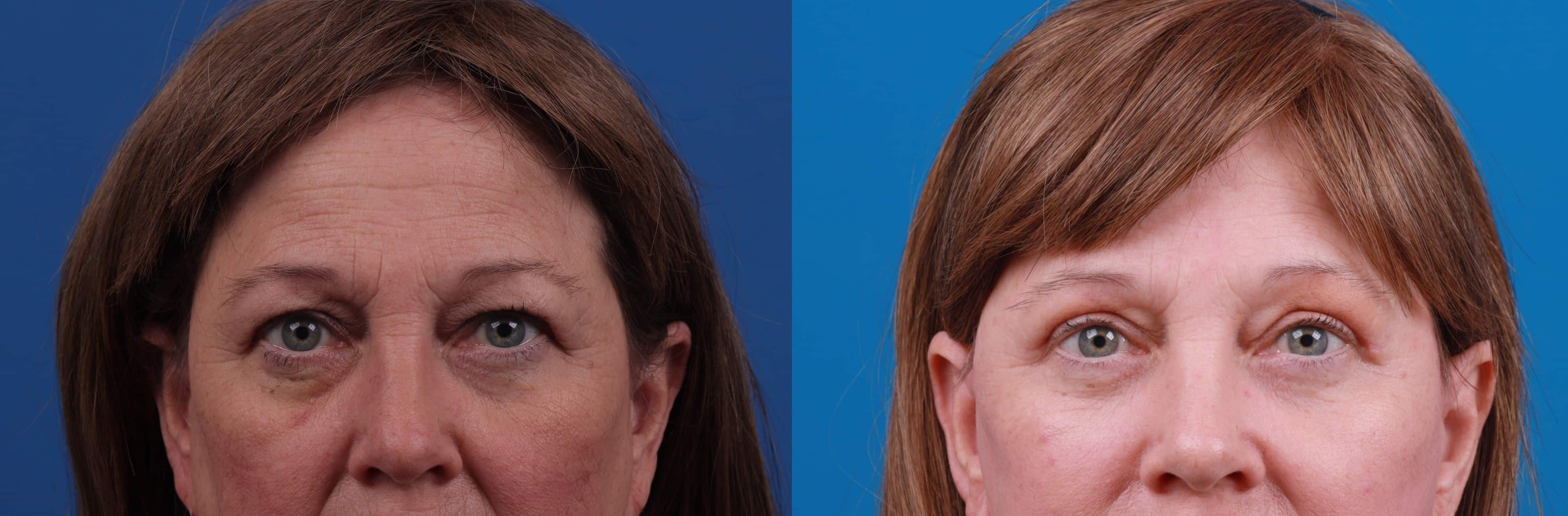 Eyelid Surgery Before & After Gallery - Patient 127787 - Image 1